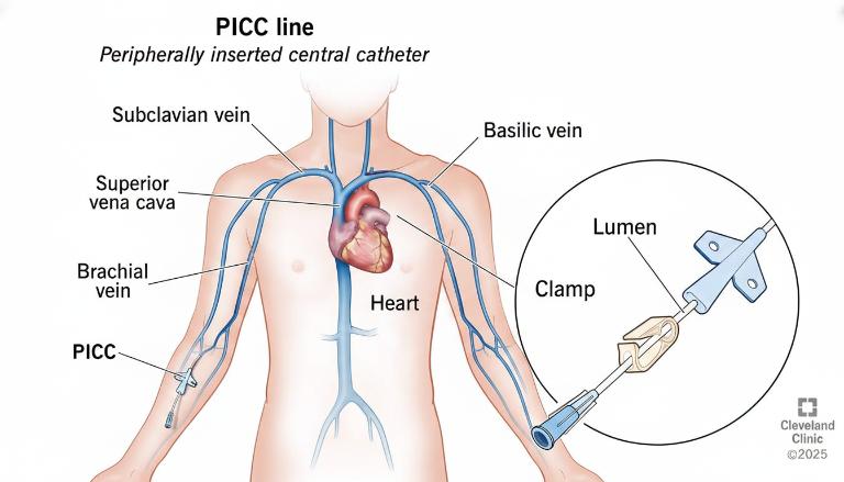  Hướng Dẫn Đặt Ống Thông Tĩnh Mạch Trung Tâm Đặt Từ Ngoại Vi Picc Chi Tiết